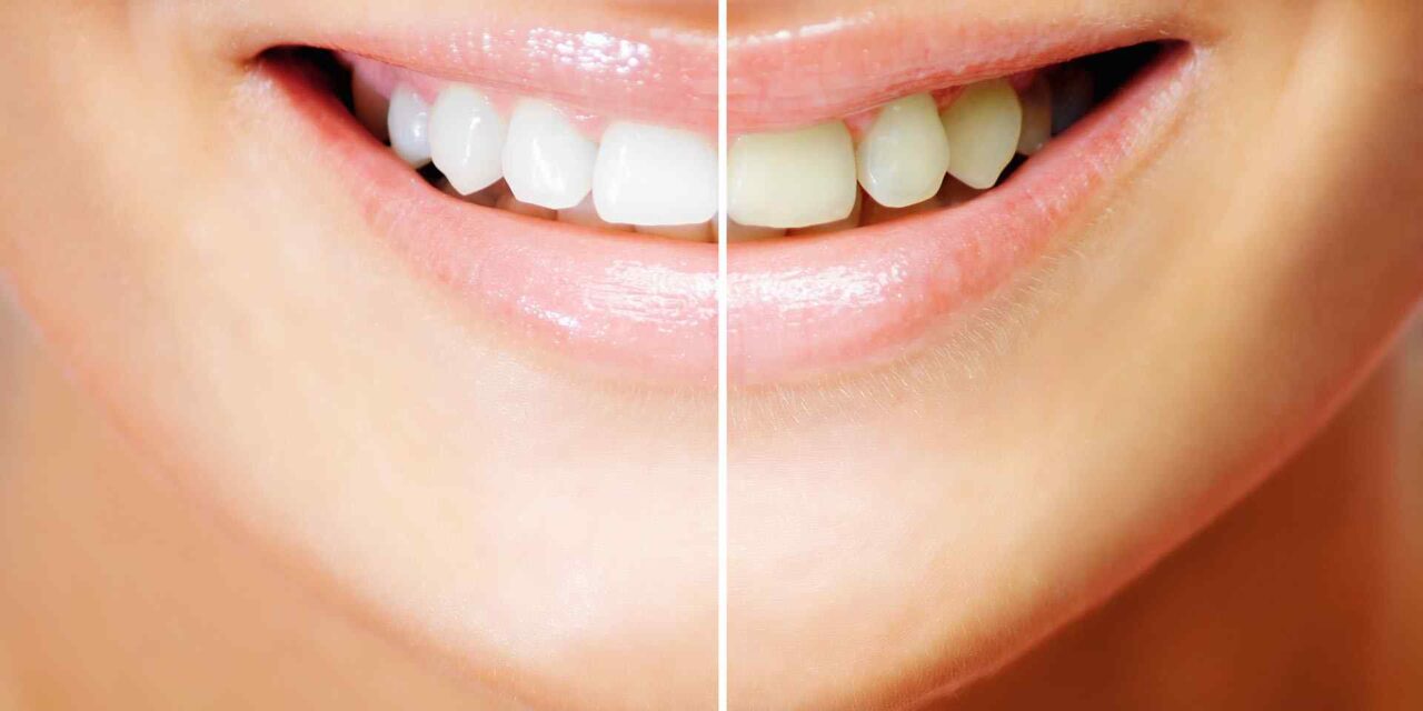 ΛΕΥΚΑΝΣΗ ΔΟΝΤΙΩΝ